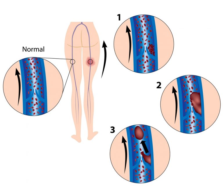 Deep vein thrombosis penis