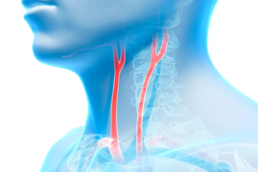 What is Carotid Artery Disease