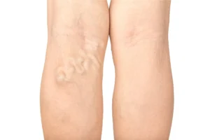 Varicose veins back of legs