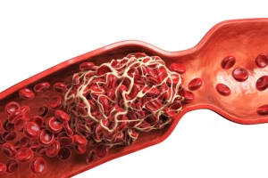 Deep Vein Thrombosis diagram